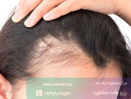 ریزش مو ارتباط مستقیمی با استرس دارد