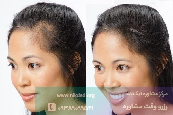 نقش استرس در ریزش موی سکه ای